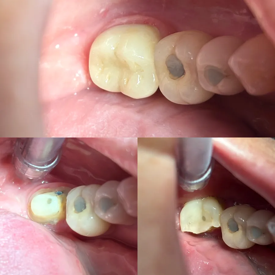 Coroa em porcelana E-max em dente posterior, do preparo ao resultado