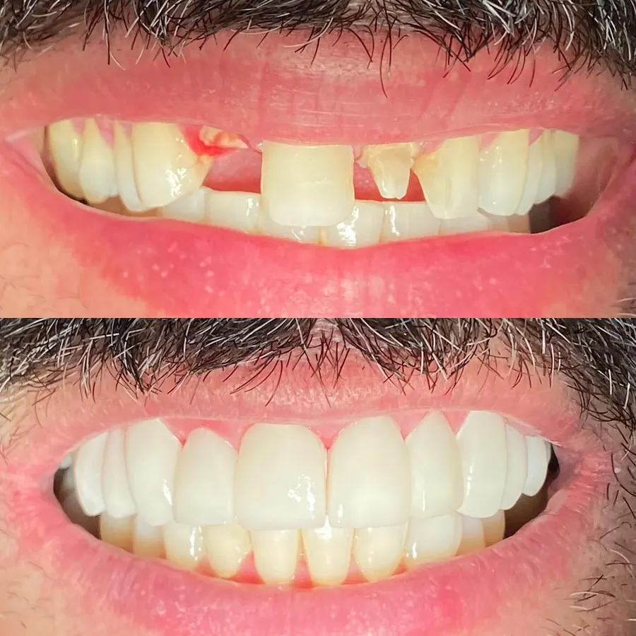 Antes e depois de facetas e coroas em porcelana nos dentes da frente
